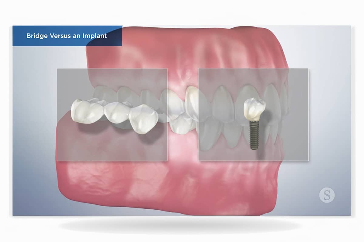 Dental implants in north andover how they work and why they last blog blog