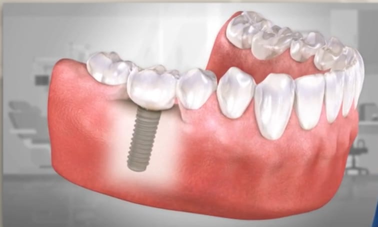 Dentalimplant image2