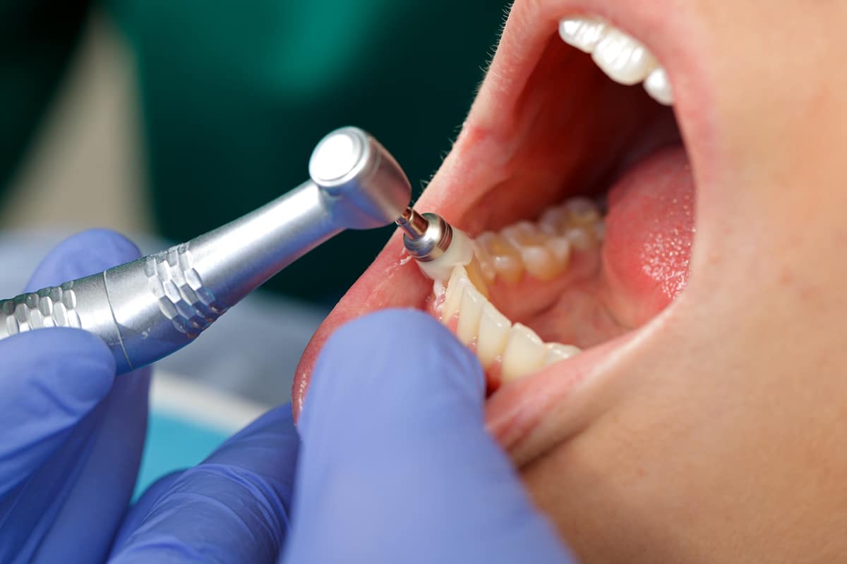 Scaling and root planing in north andover deep cleaning for healthier gums blog