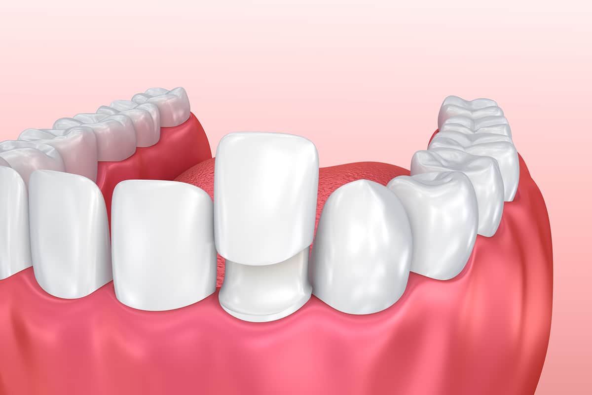 Whats the difference between dental bonding and veneers in north andover ma blog
